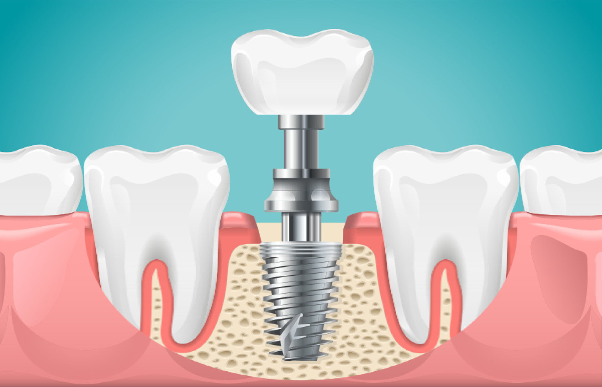 dental implants