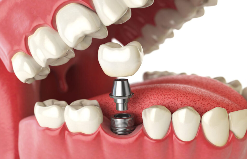 What are the benefits of dental Implants