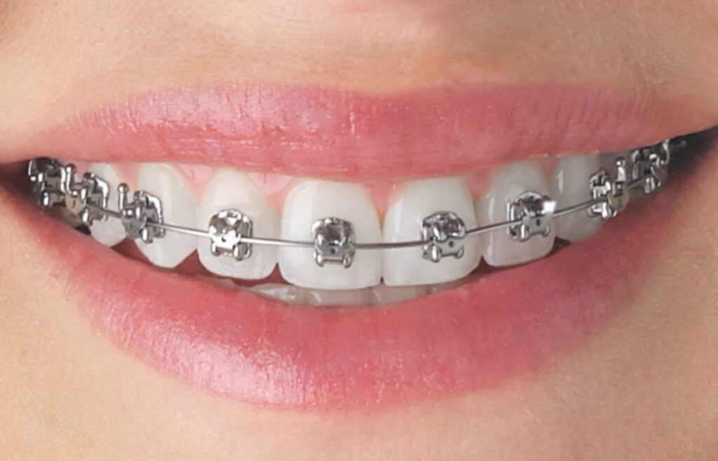 The Benefits of Orthodontic Treatment: A Straight Smile, a Healthy Life