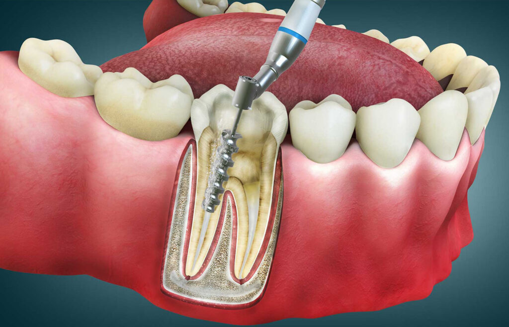 The Benefits of Root Canal Treatment