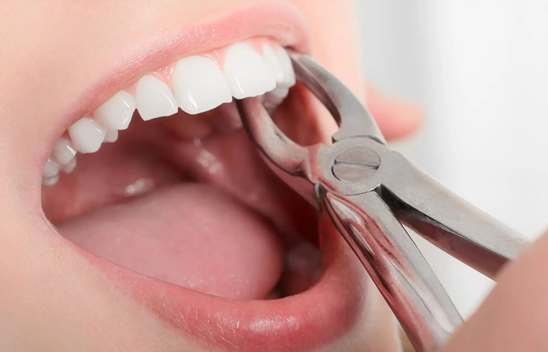 teeth extraction